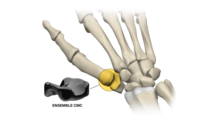 Ensemble Orthopedics Receives FDA Clearance for Implant