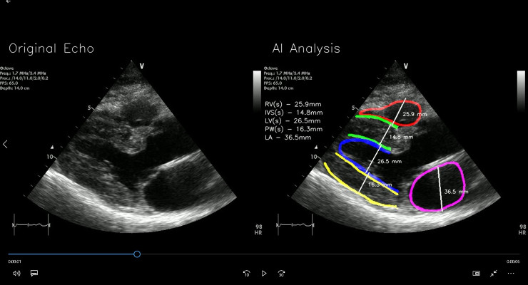 RSIP Vision Announces New Cardiac Diagnostic Tool for PoC Ultrasound Screening