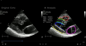 RSIP Vision Announces New Cardiac Diagnostic Tool for PoC Ultrasound Screening