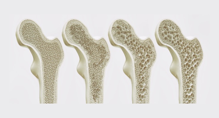 Osteoporosis Prevention Product Wins FDA Breakthrough Device Designation
