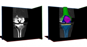 RSIP Vision Announces Metal Implant & Anatomical Segmentation Tool
