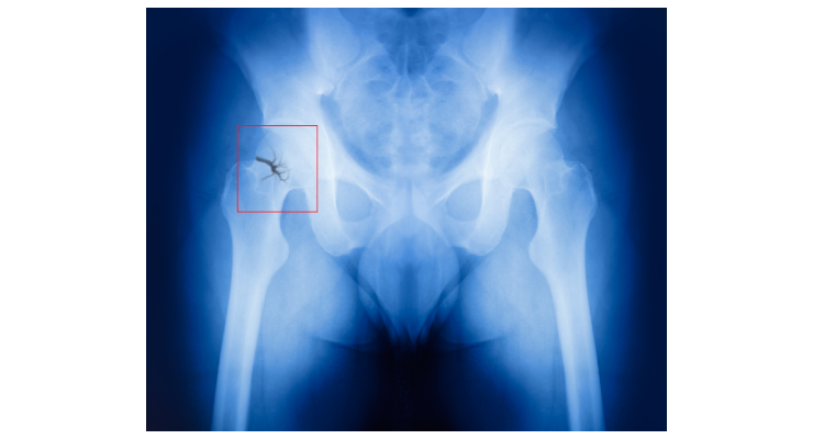 Study Reveals Three Most Important Aspects of Hip Fracture Care 