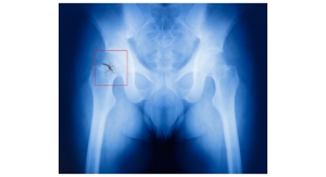 Study Reveals Three Most Important Aspects of Hip Fracture Care 