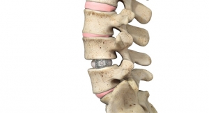 Spineology Launches Duo Ti Expandable Interbody Fusion Procedure