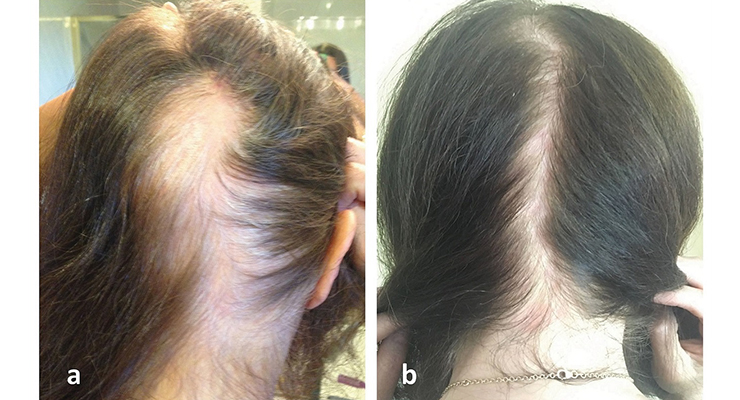 Ludwig Scale | Female Baldness Pattern - Heva Clinic