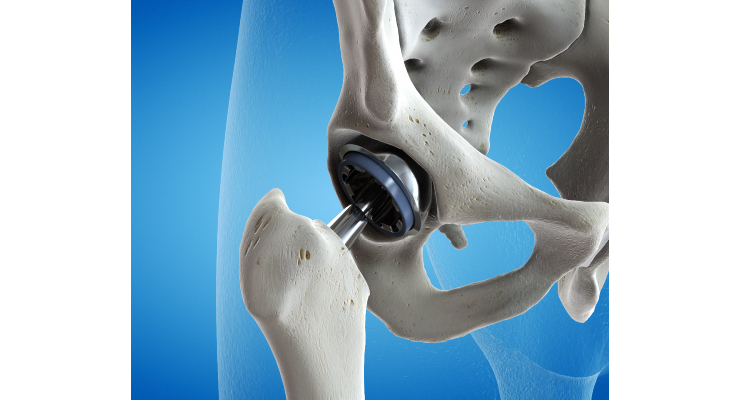HSS Study Finds Hip Replacements Increasing Among Adolescents