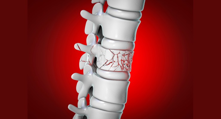 Vertebral Compression Fracture Overview, DePuy Synthes