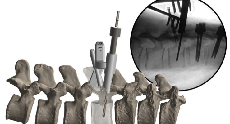 OrthoPediatrics Marks 1,000th Case Using FIREFLY Pedicle Screw Guides
