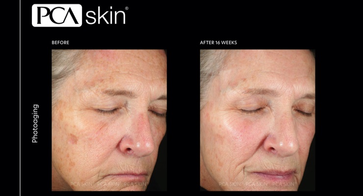 PCA Skin Introduces New Pigment Gel Pro Dark Spot Treatment