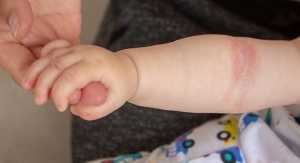 J&J and SciBase Collaborate on Screening Tool to Detect Skin Barrier Dysfunction in Infants 