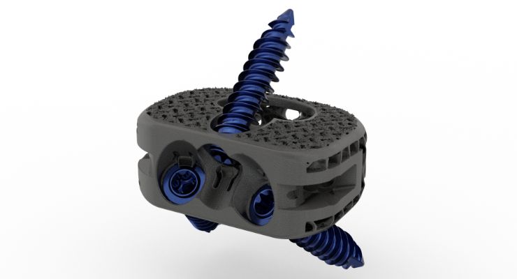 Orthofix Launches 3D-Printed WaveForm A ALIF