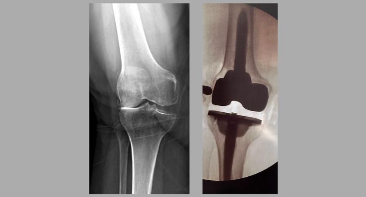 Total Joint Orthopedics Announces First Revision Total Knee Arthroplasty Using Klassic Knee