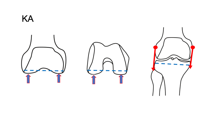 Total Knee Arthroplasty: Technique or Technology?