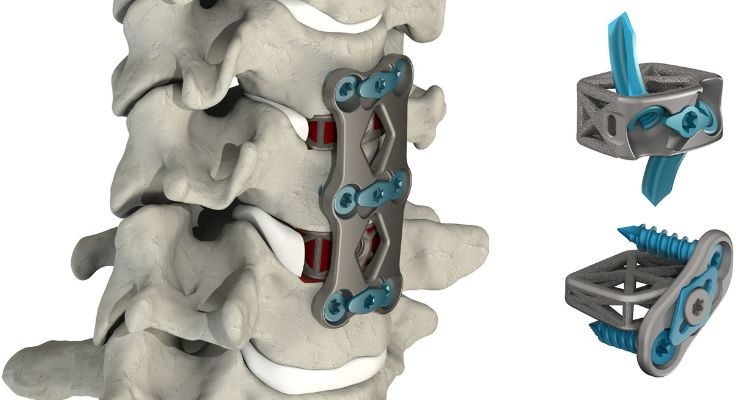 4WEB Medical Releases Cervical Spine Plating Solution