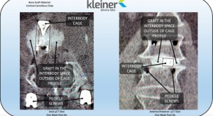 Kleiner Device Labs Completes 50th Case With KG2 Surge Interbody System