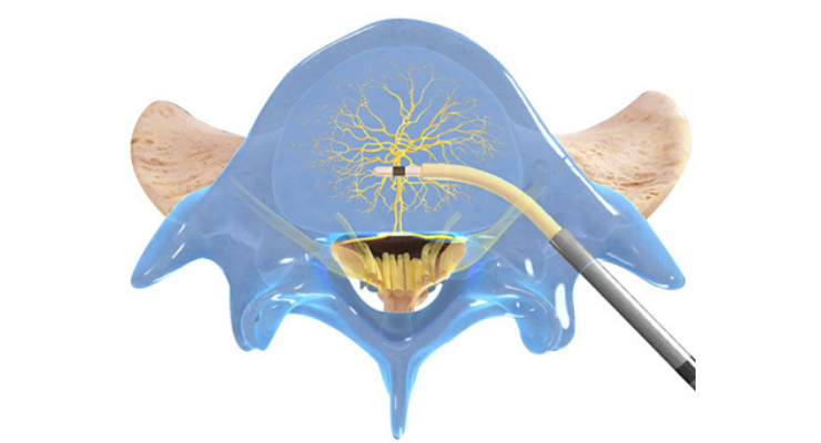 Clinical Data Validate Efficacy of Intracept Procedure for Lower Back Pain 