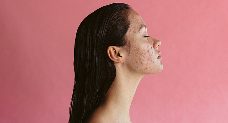 Study Examines Narasin For Human Acne Treatment