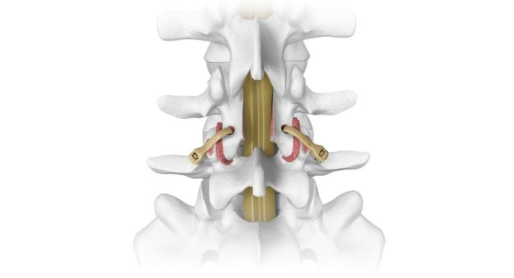 NASS News: Spinal Elements to Feature Karma Fixation Solution