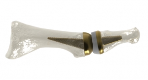 AAOS24: First 3D Printed Toe Joint Replacement Being Showcased
