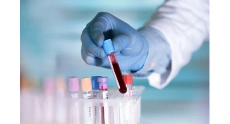 Scientist Develop Simple Blood Test to Diagnose Sarcoidosis