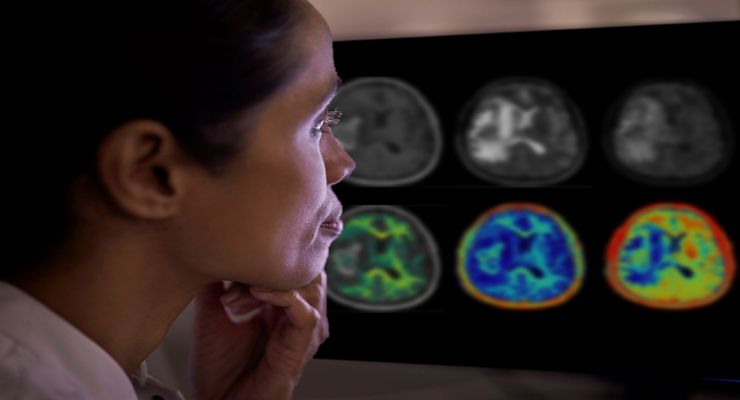 Philips and Synthetic MR Partner for AI-based Brain Imaging Technology