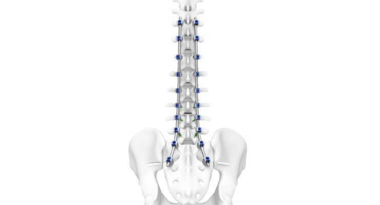 DePuy Synthes Releases TriALTIS Spine System