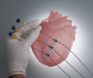 First Transcatheter Clinical Procedure Performed with Revivent-TC System from BioVentrix 