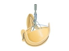 First U.S. Implant of New Stentless Valve from Sorin