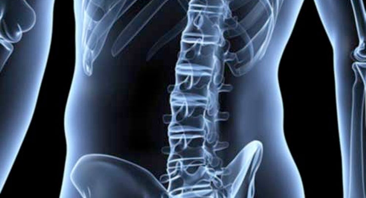 Spineology Awarded Patent for Spine Fusion System and Procedure