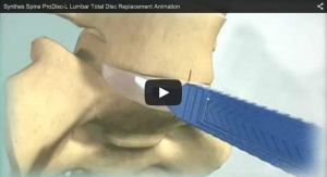 Synthes Spine ProDisc-L Lumbar Total Disc Replacement Animation 