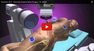 NuVasive XLIF - Minimally Invasive Spine Surgery